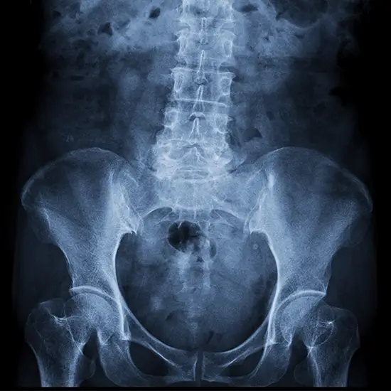 X-ray Right Hip LAT View